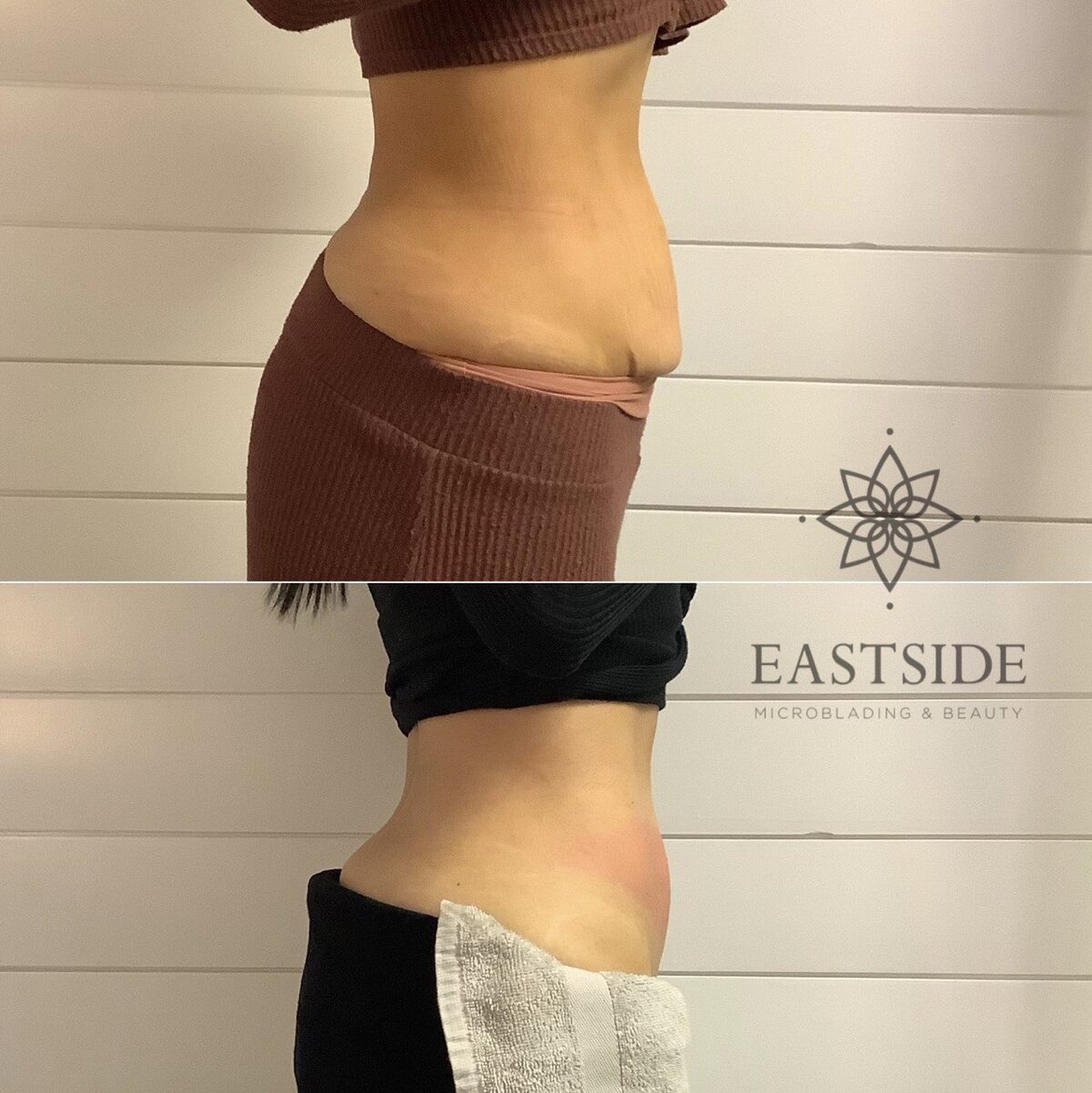 Real cryo body sculpting abdomen before and after result from Eastside Bellevue WA client