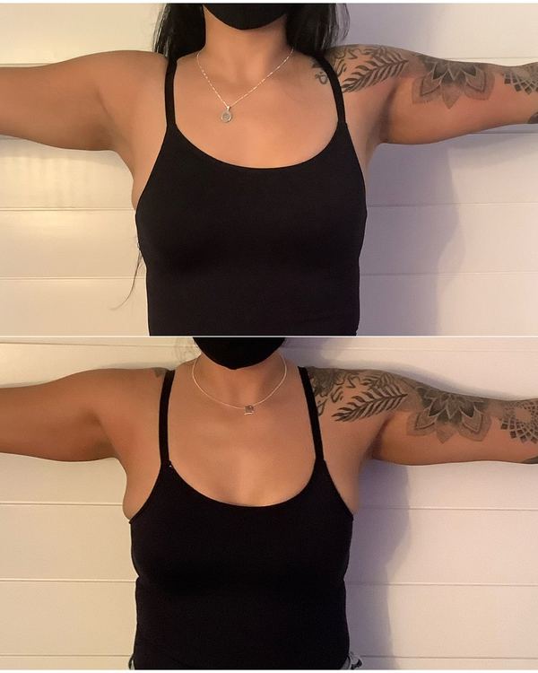 Cryo body sculpting arms before and after result from Eastside Bellevue studio client