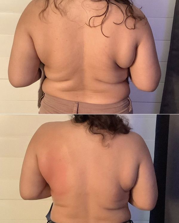 Cryo body sculpting back before and after result from Eastside Bellevue studio client