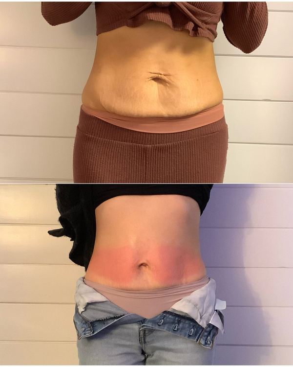Cryo body sculpting session in progress at Eastside Microblading Bellevue studio