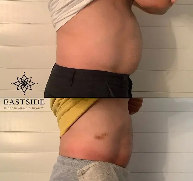 Male body contouring before and after