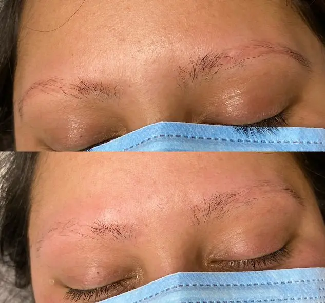 Permanent makeup removal at Eastside Microblading & Beauty