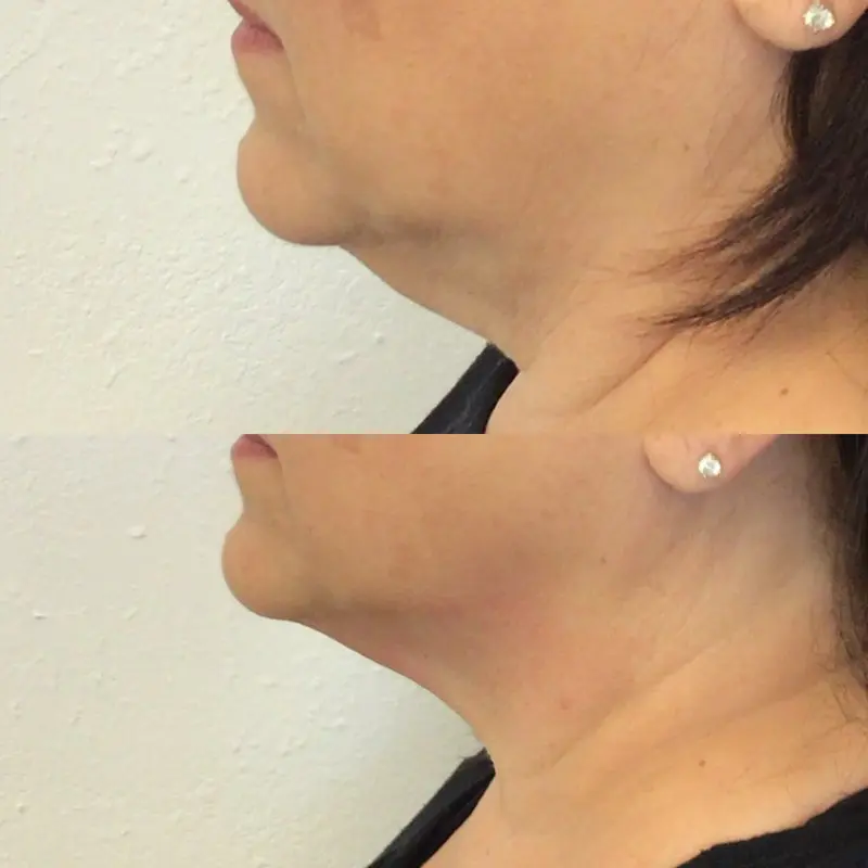 Medical-grade cryo body sculpting equipment at Eastside Microblading & Beauty