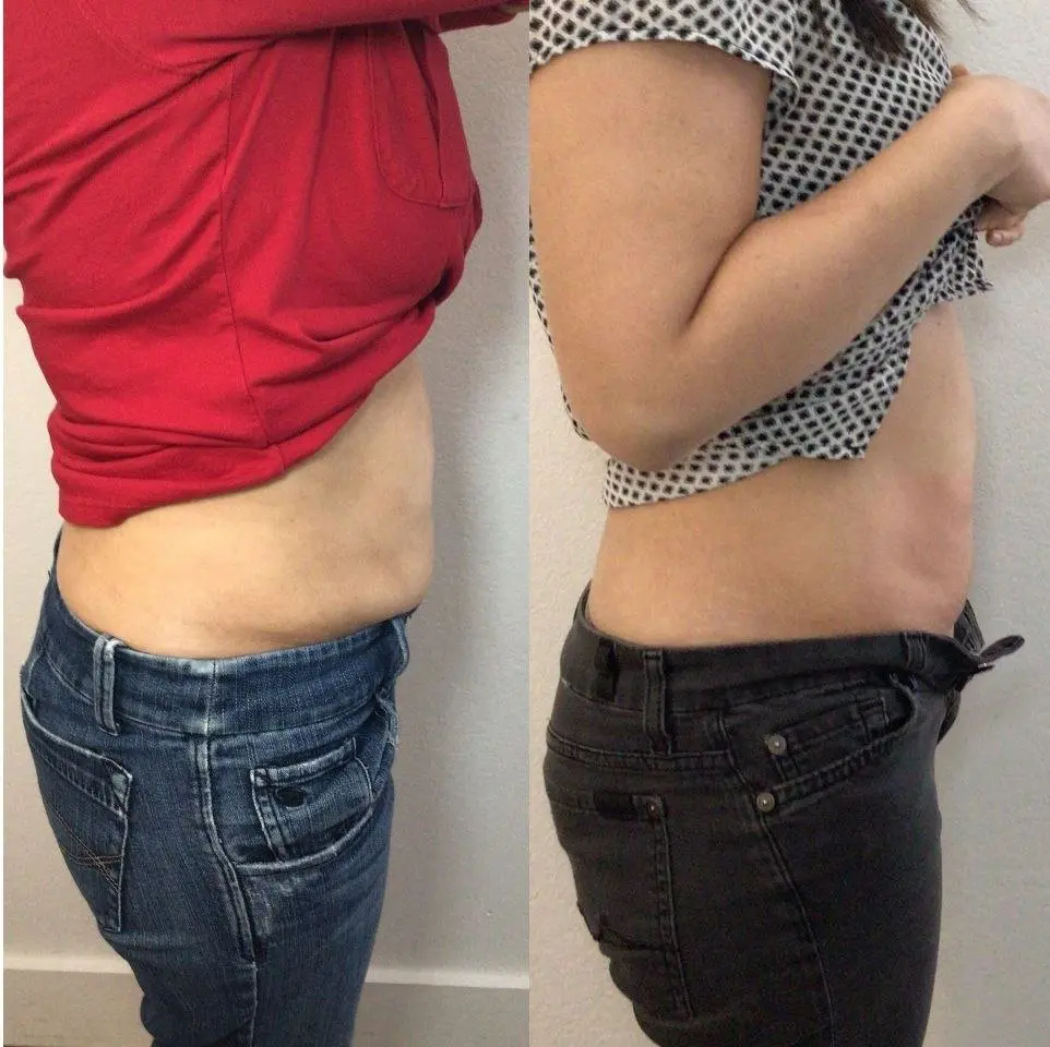Cryolipolysis fat freezing at Eastside Microblading & Beauty