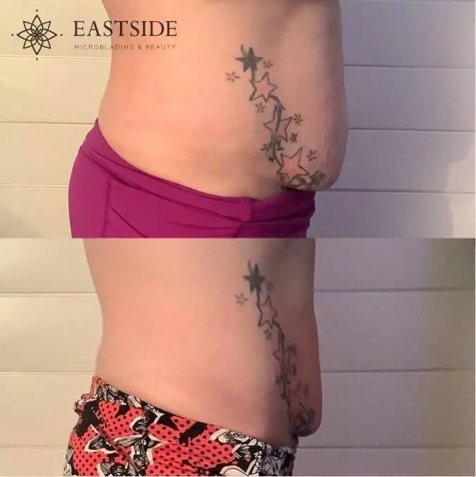 Cryo facial and double-chin treatment at Eastside Microblading & Beauty