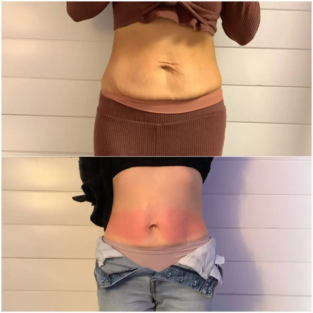 Manual cryo body sculpting session at Eastside Microblading & Beauty