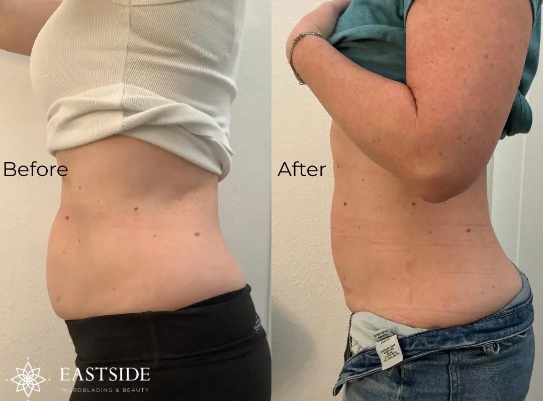 Client's abdomen before and after cryo body sculpting