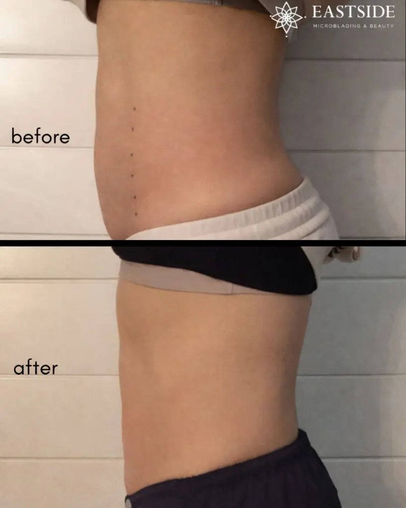 Back cryolipolysis before and after, Eastside watermarked result