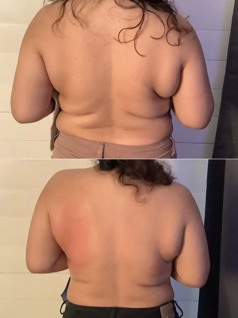 Back before and after cryo body sculpting