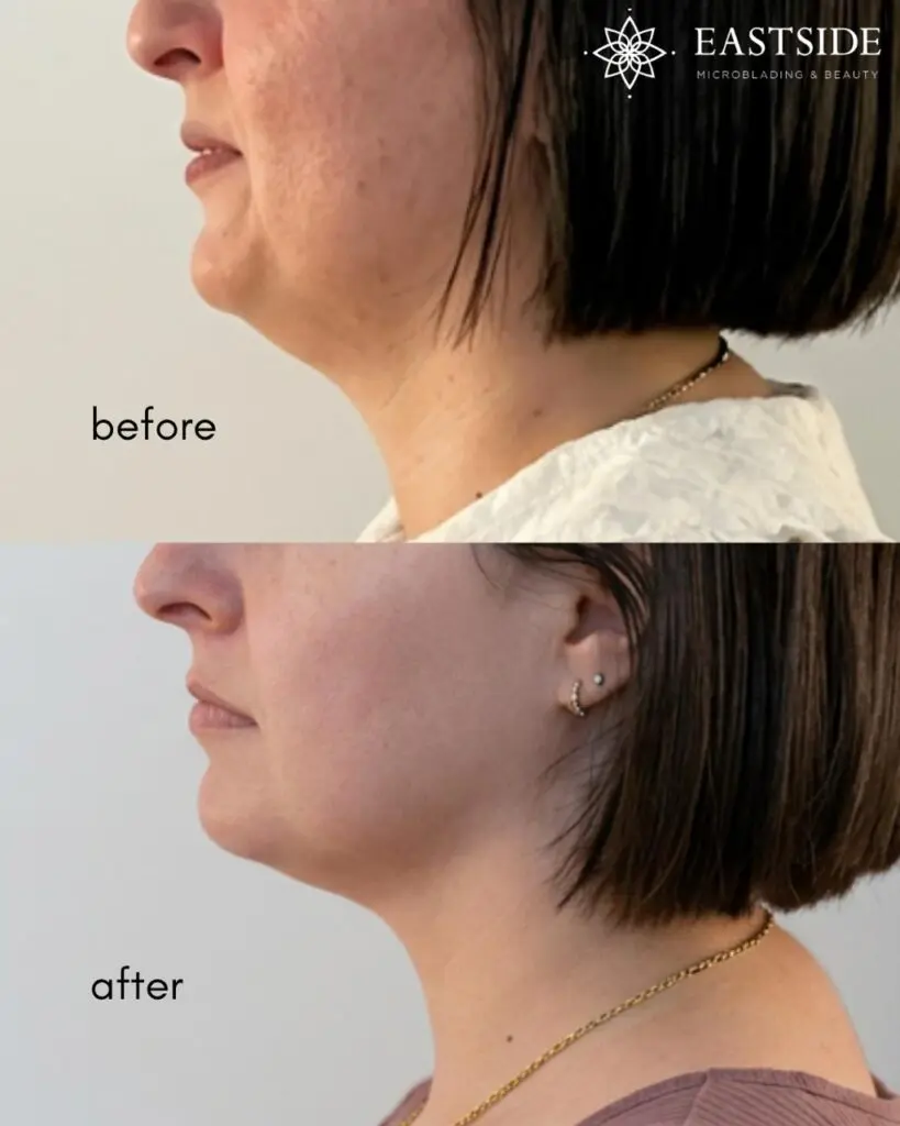 Chin profile before and after a cryo facial