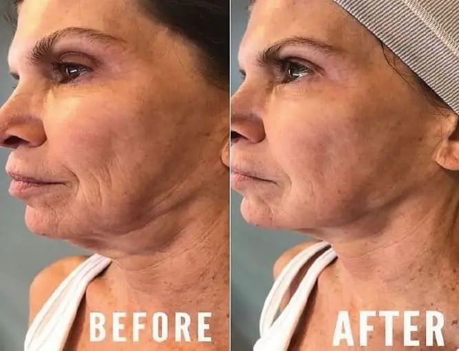 Facial profile before and after a cryo facial