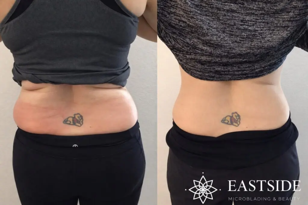 Flank before and after cryo body sculpting