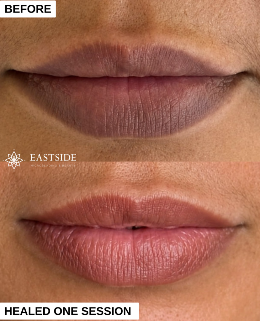 Three stages of a lip neutralization treatment