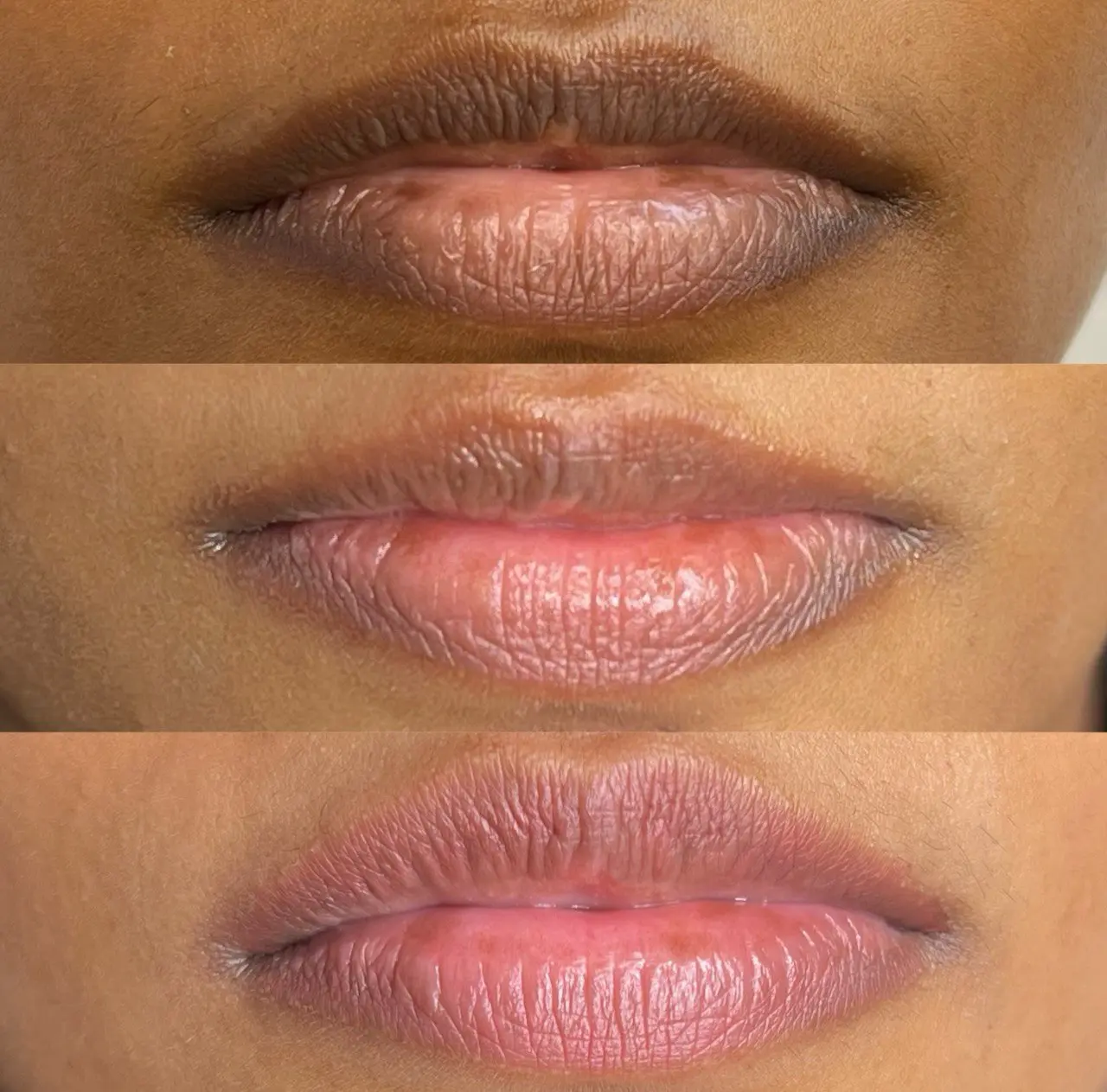 Three stages of a lip neutralization treatment