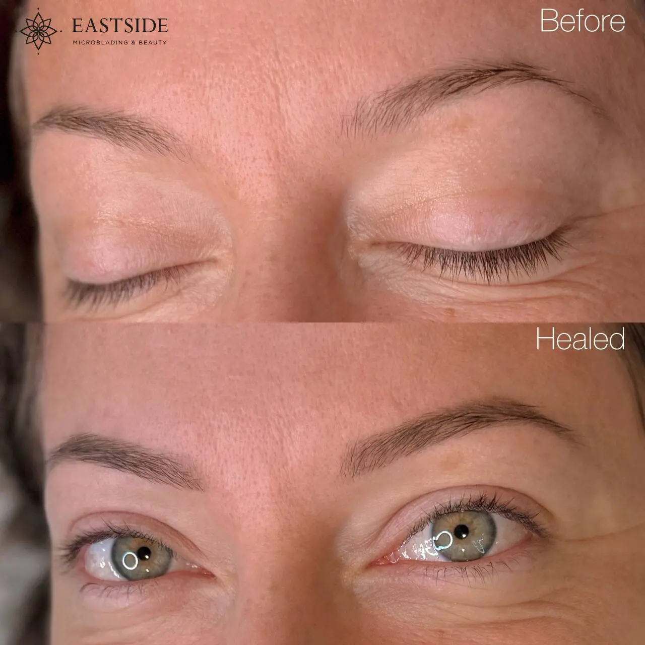 Brow before-and-healed result, Eastside client