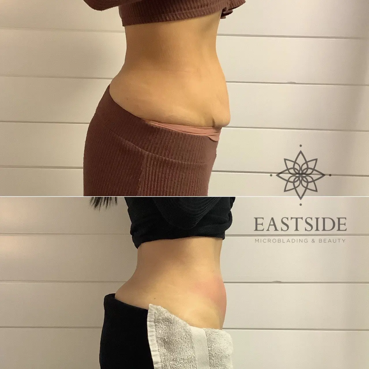 Abdomen profile: Eastside cryo client before and after