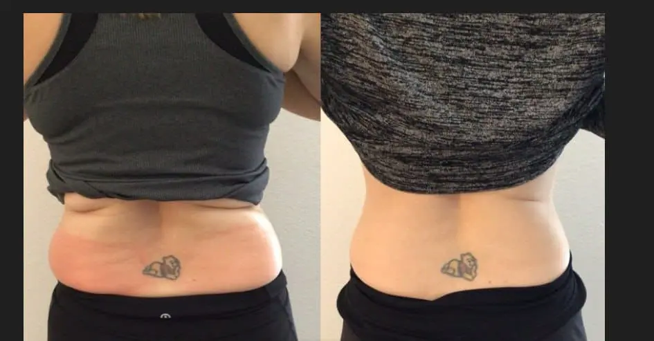 Back and waist: Eastside cryo client before and after