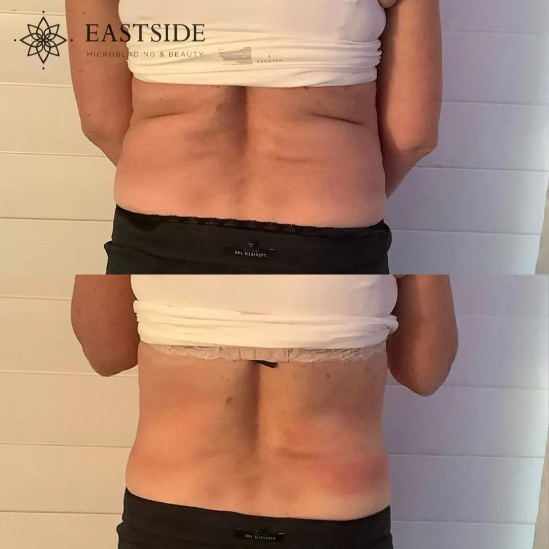 Back and waist: Eastside cryo client before and after