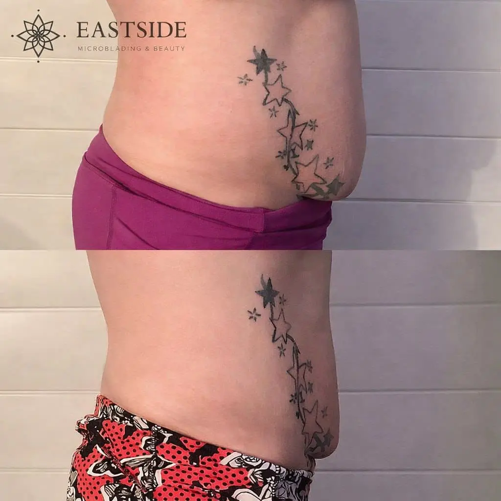 Abdomen: Eastside cryo client before and after