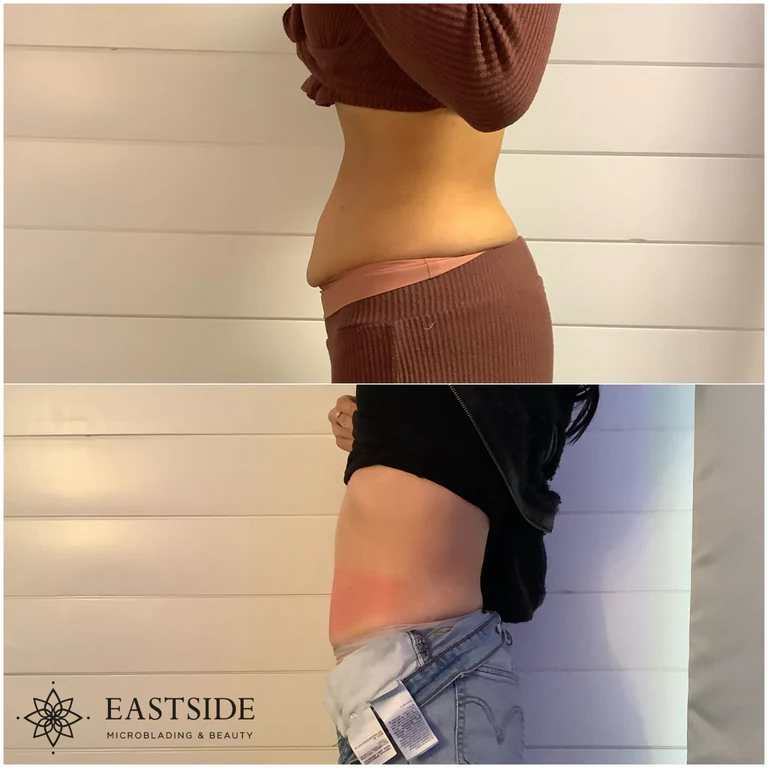 Eastside client result: cryo fat sculpting