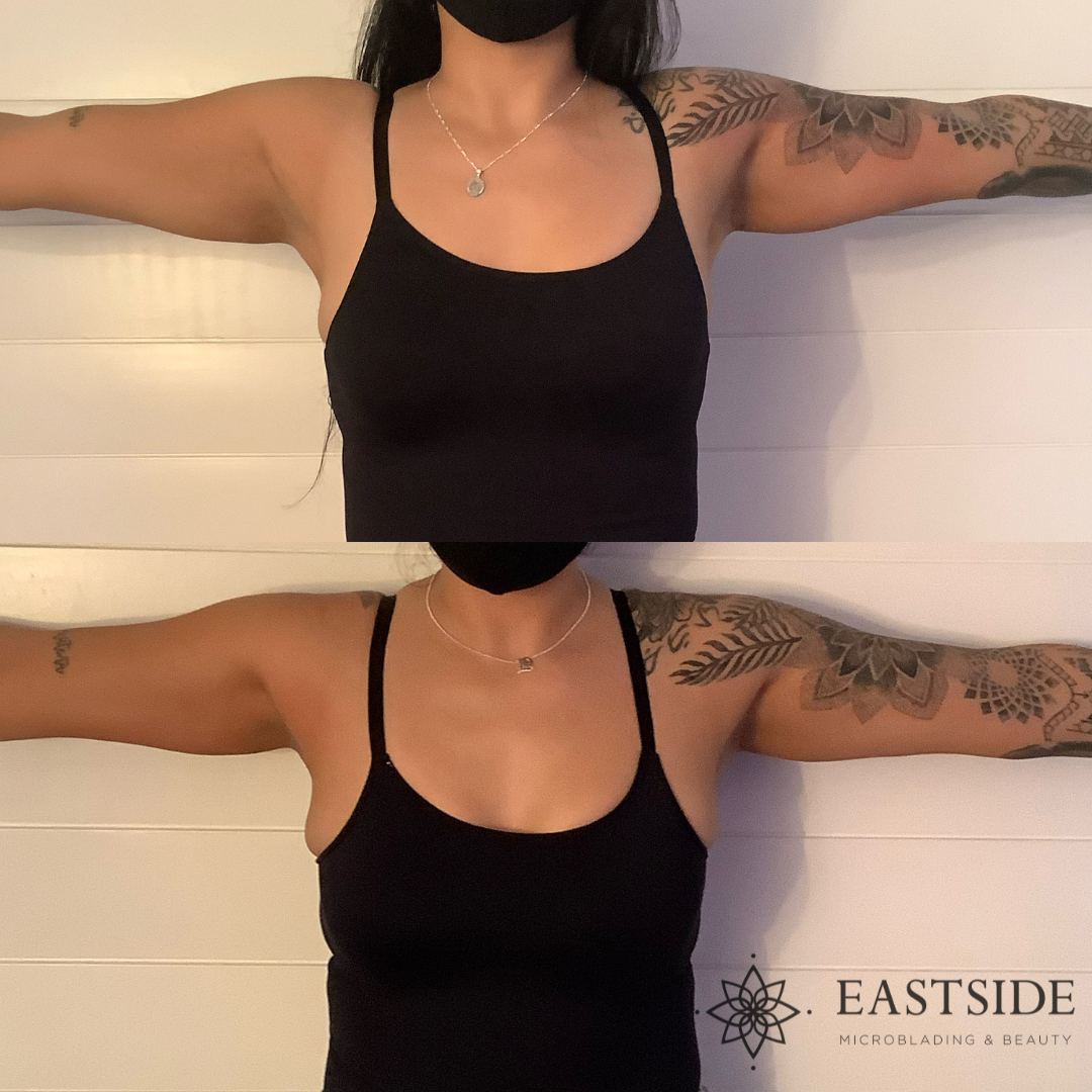 Cryo body sculpting · before & after