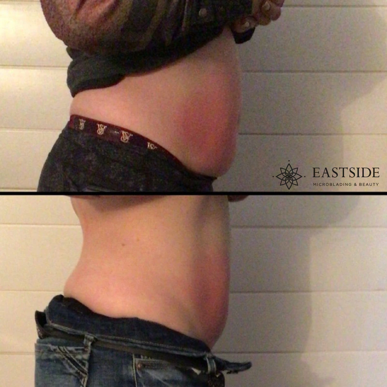 Eastside client result: cryo fat sculpting