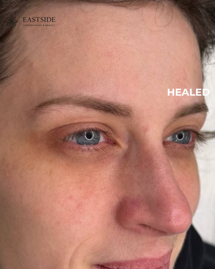 Brow treatment progression from before to healed