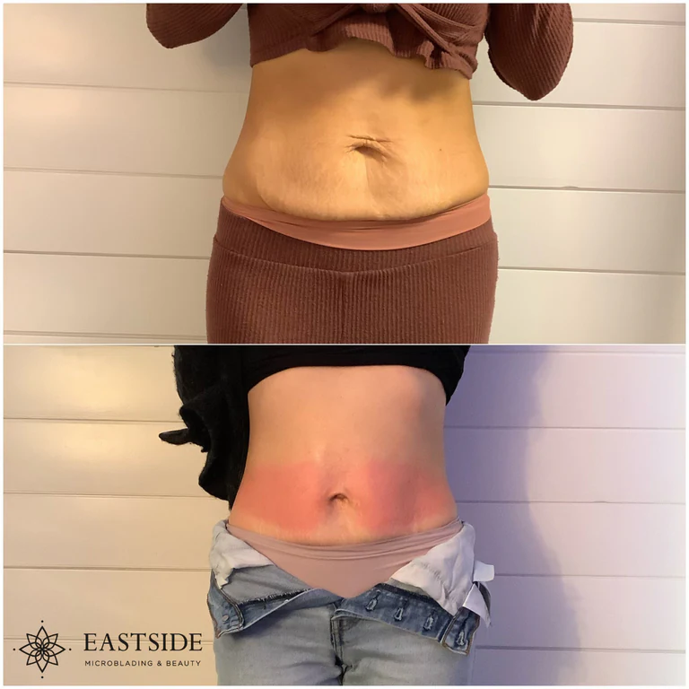 Eastside client result: cryo fat sculpting