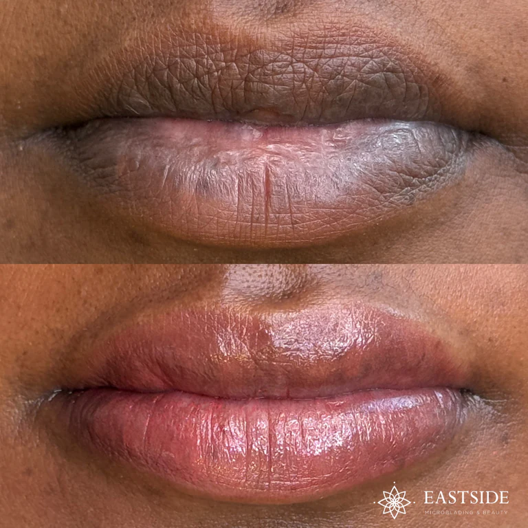 Eastside client result: lip neutralization