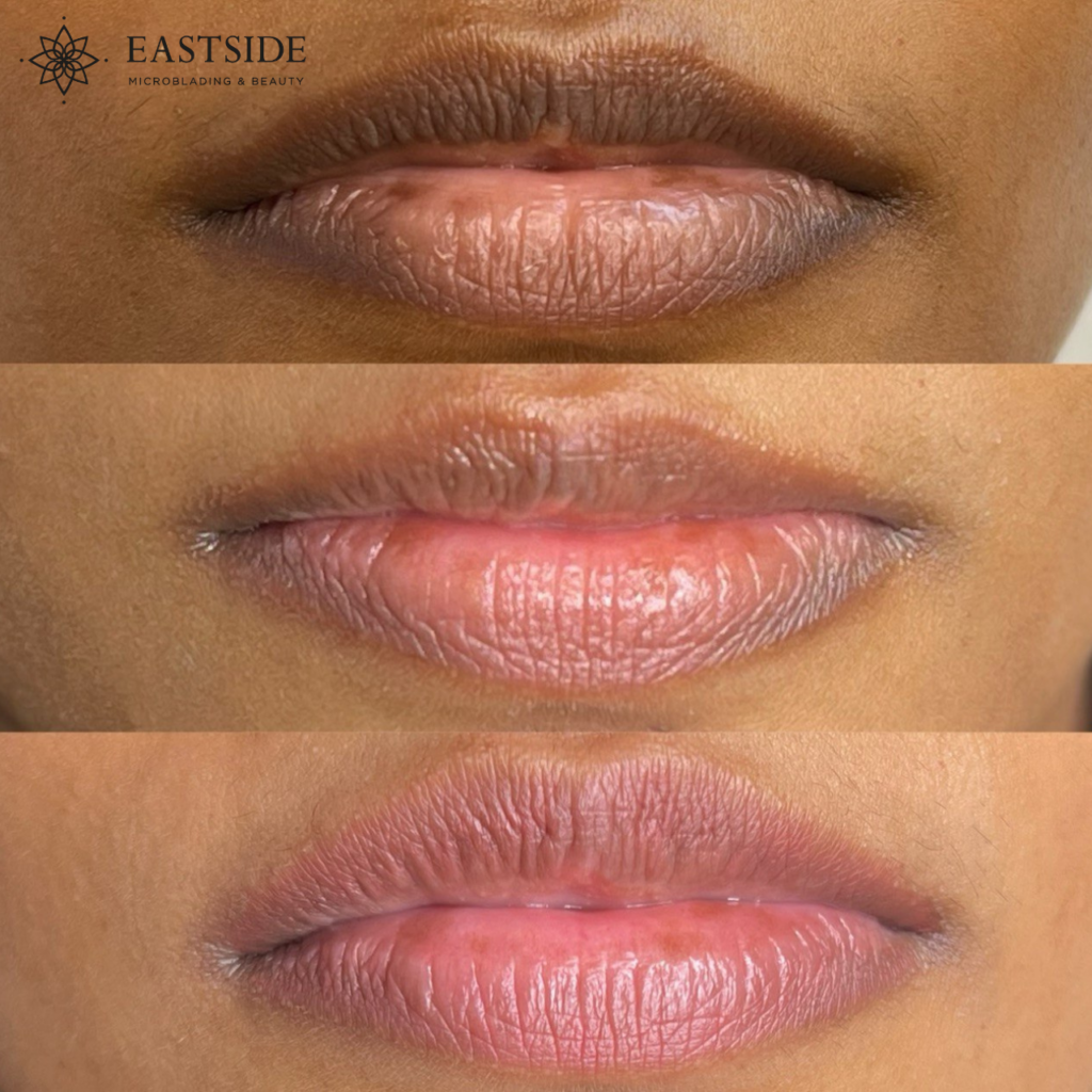 Lip neutralization before treatment and healed after one session