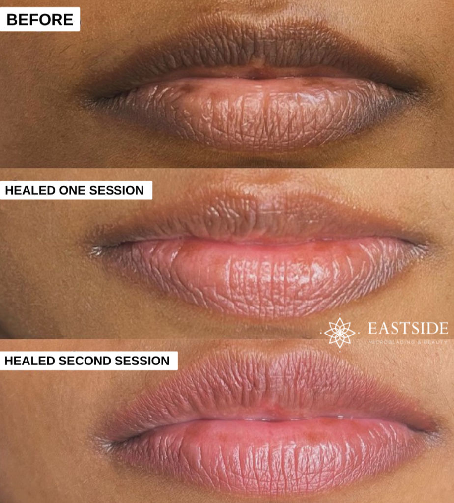 Lip neutralization before treatment and healed after one session