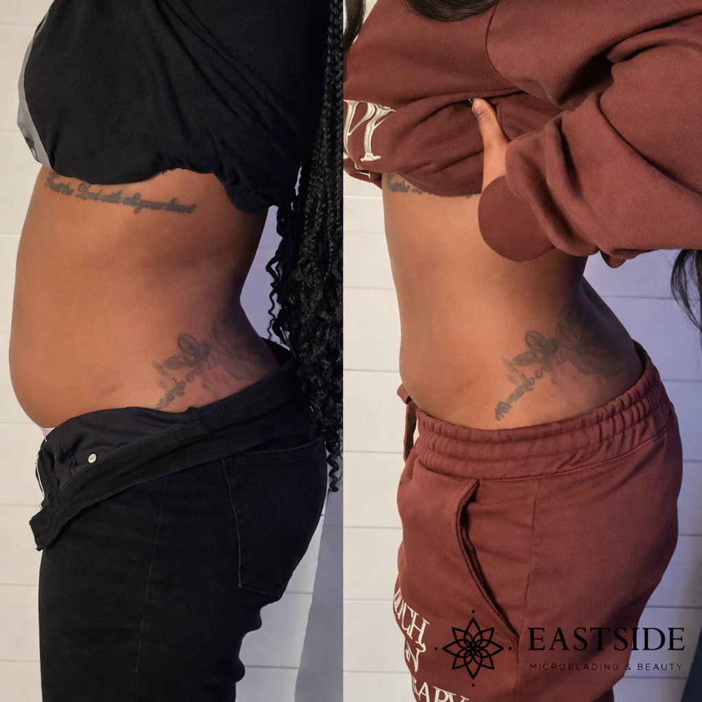 Chin profile before and after a cryo facial