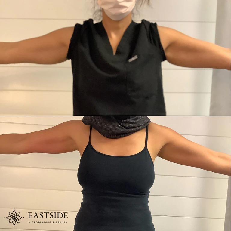 Eastside client result: cryo fat sculpting