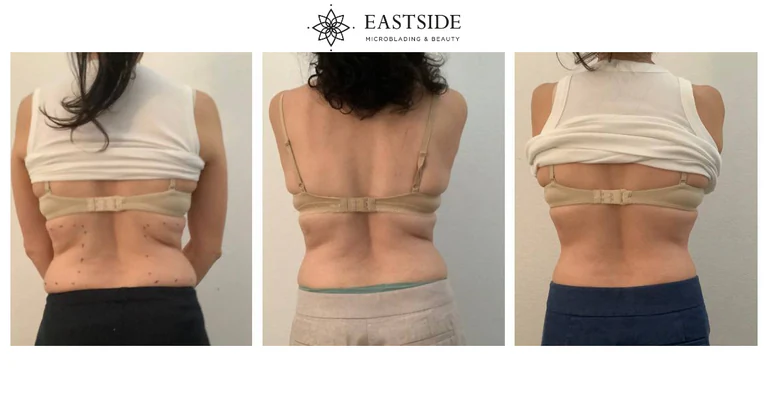 Eastside client result: cryo fat sculpting